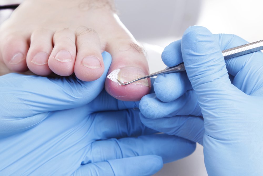 Ingrowing Toenail